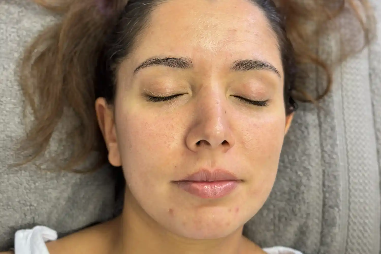 After Botox treatment