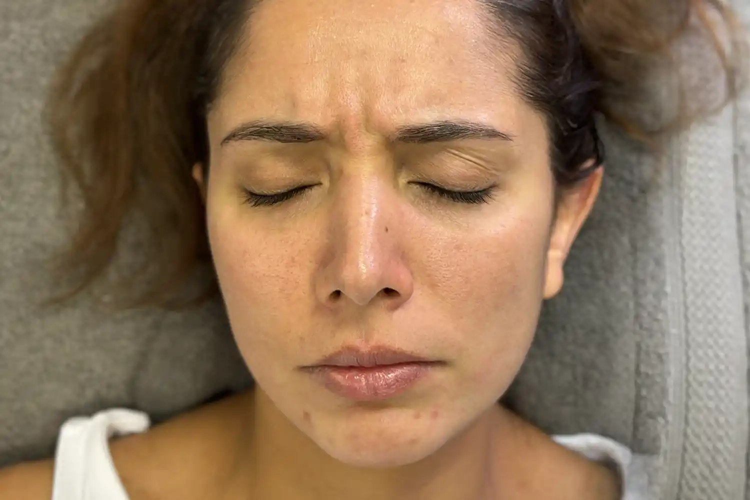 Before Botox treatment