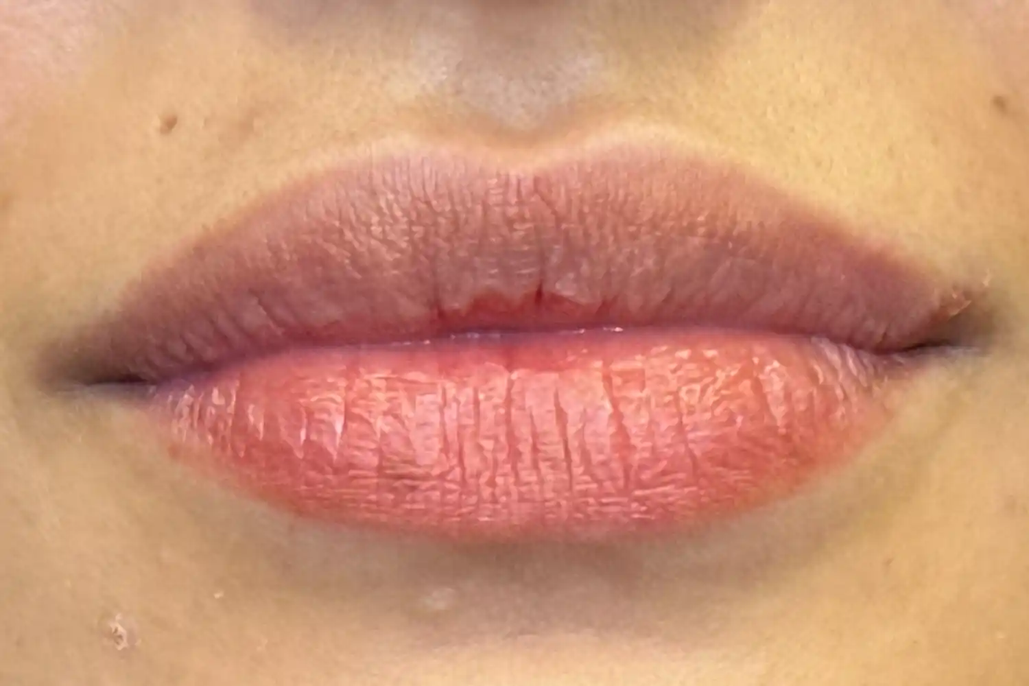 After dermal filler treatment