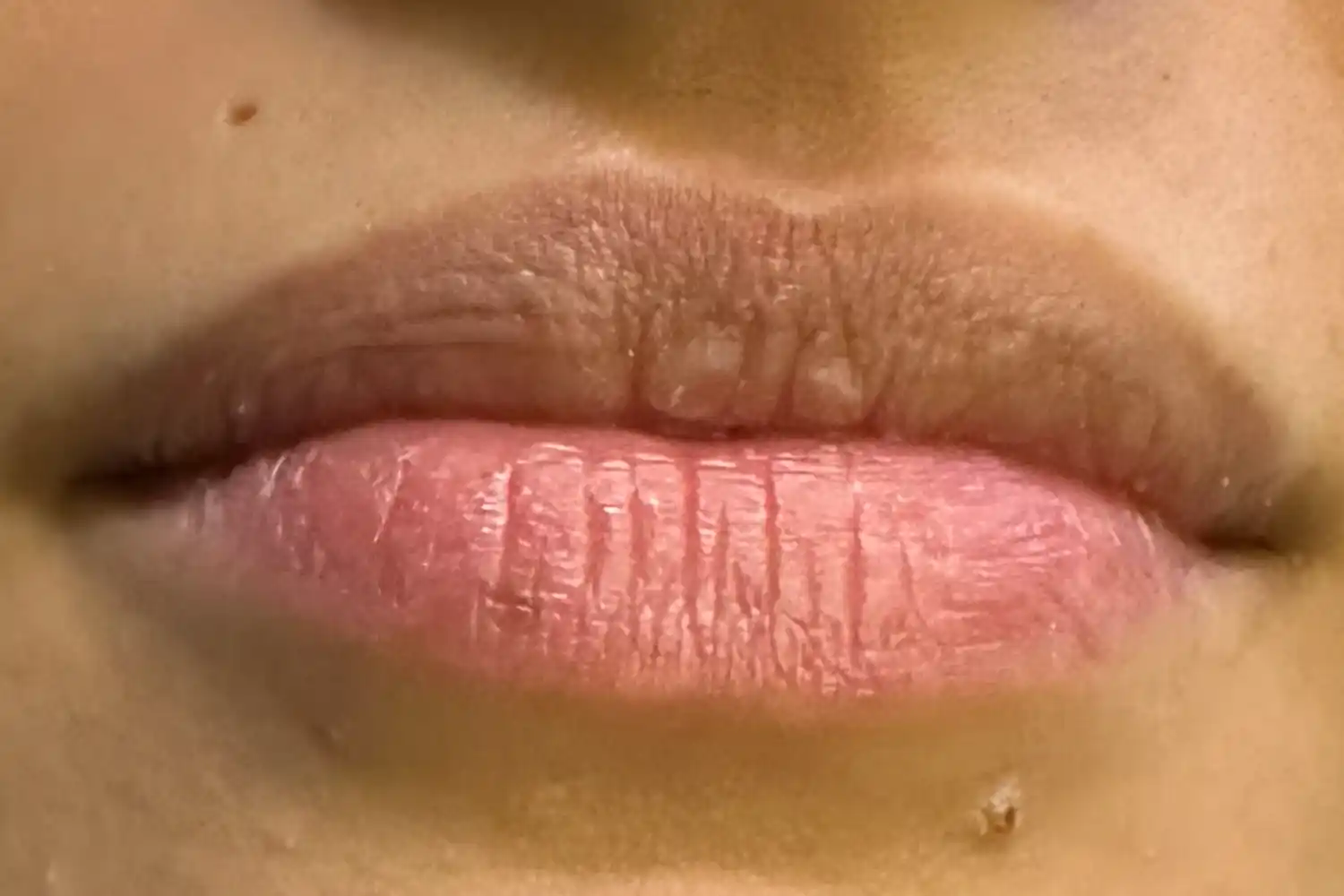 Before dermal filler treatment