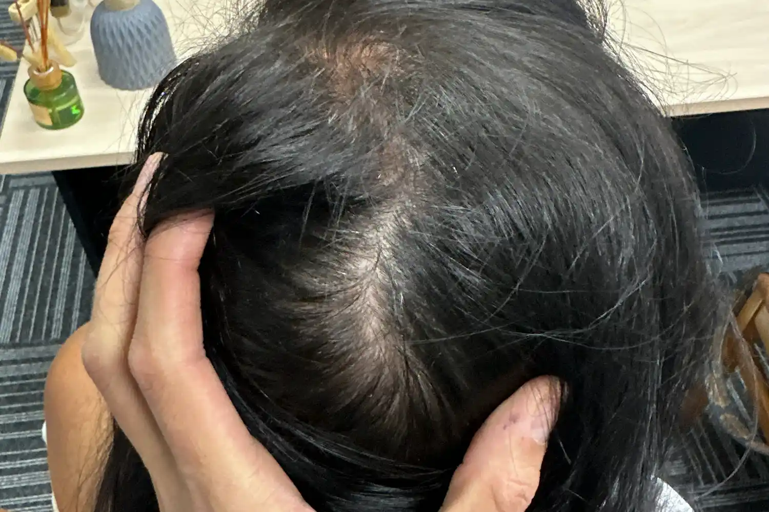 After PRP treatment, result 02