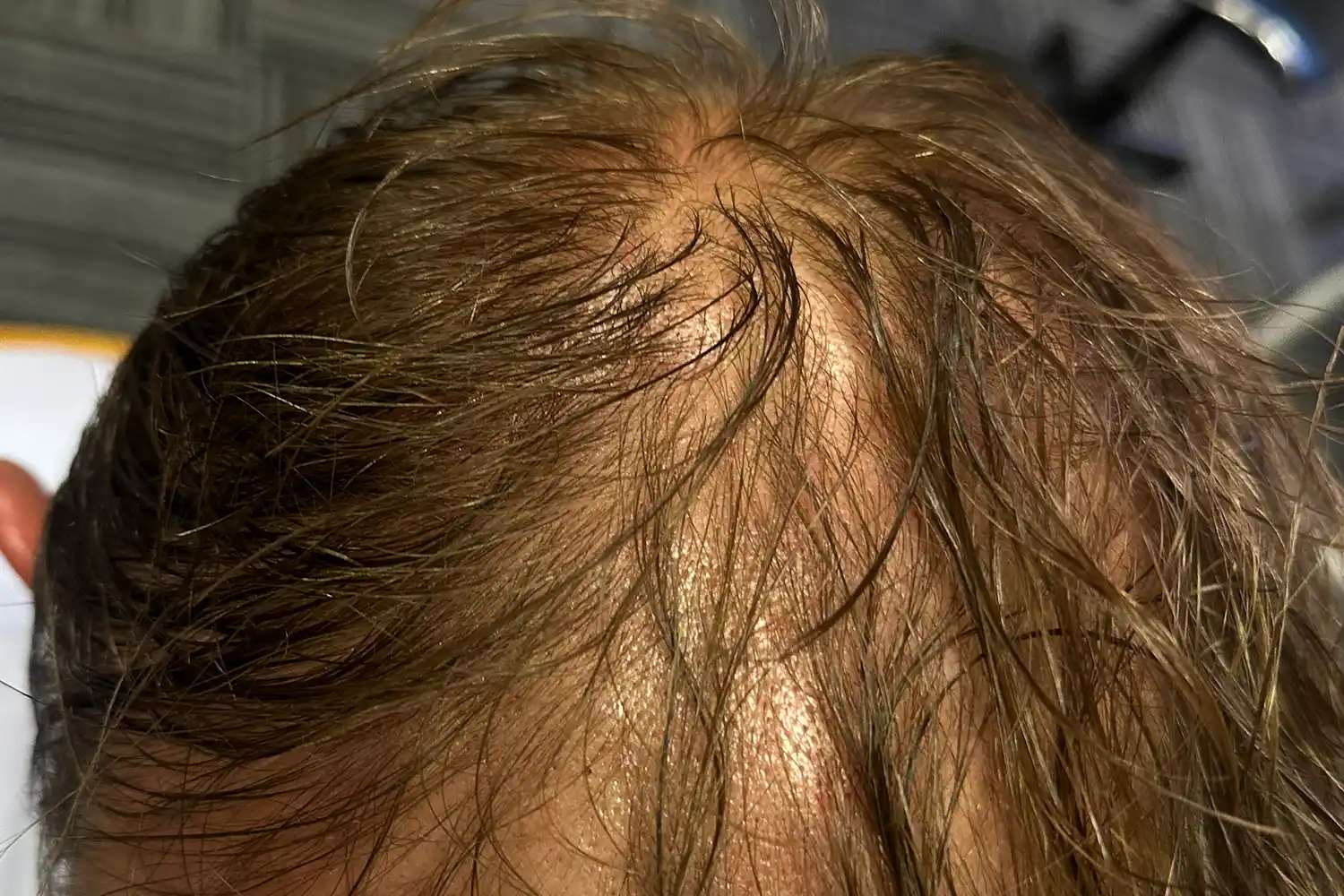 After PRP treatment, result 03