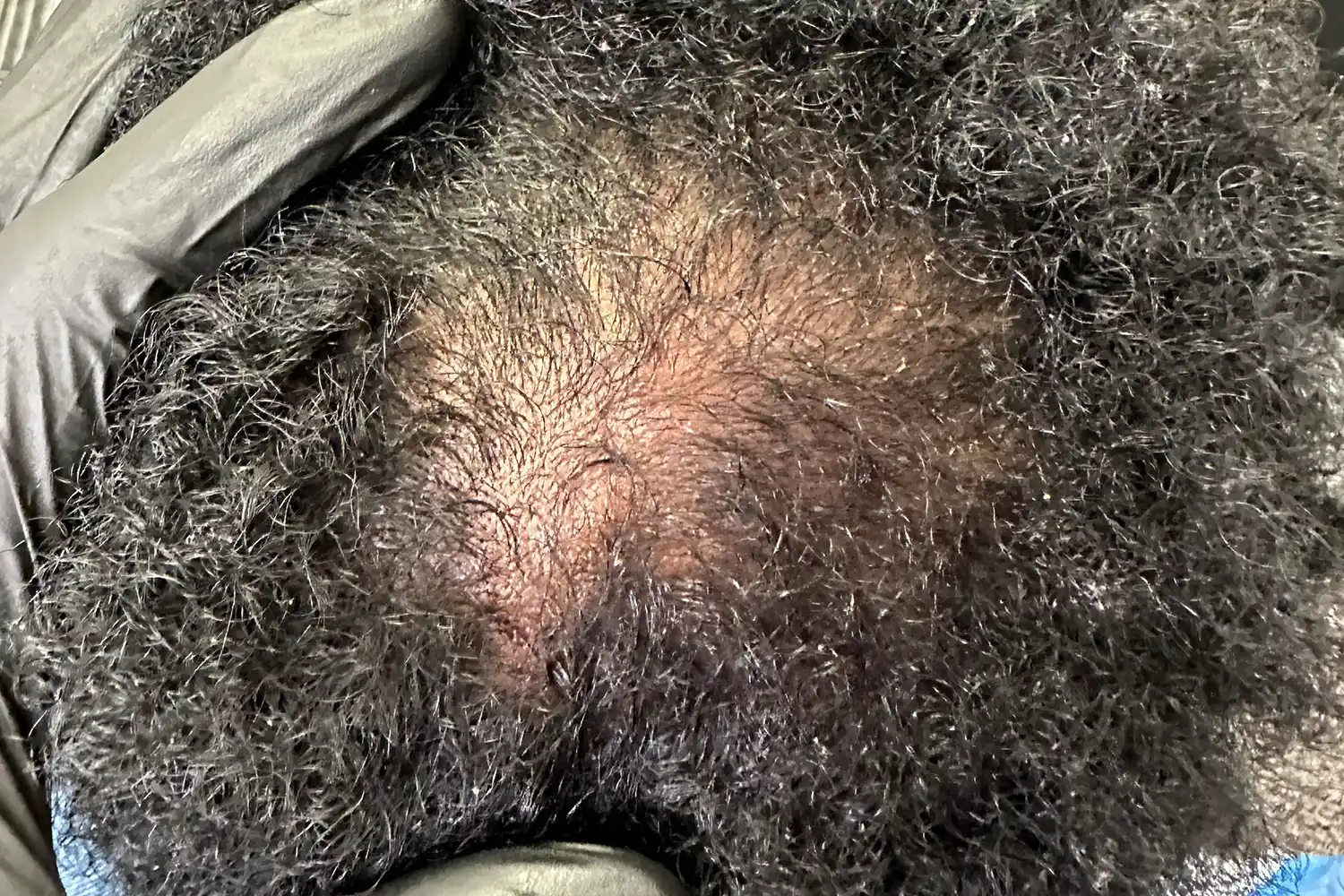 Before PRP treatment, result 01
