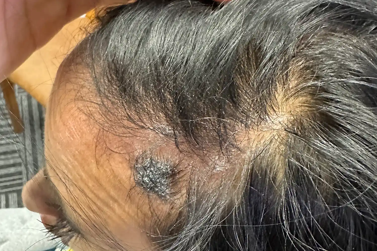 Before PRP treatment, result 02