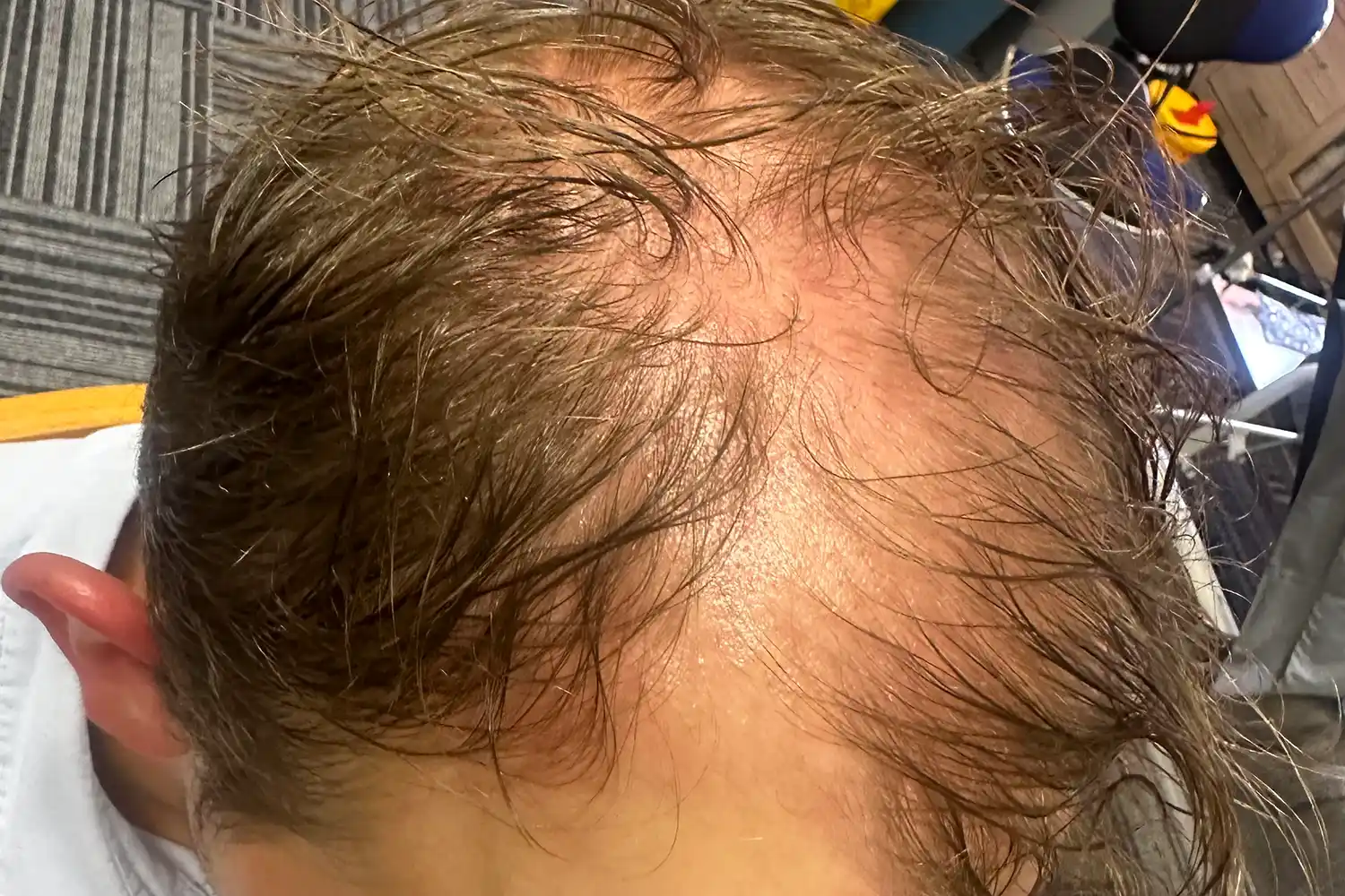 Before PRP treatment, result 03