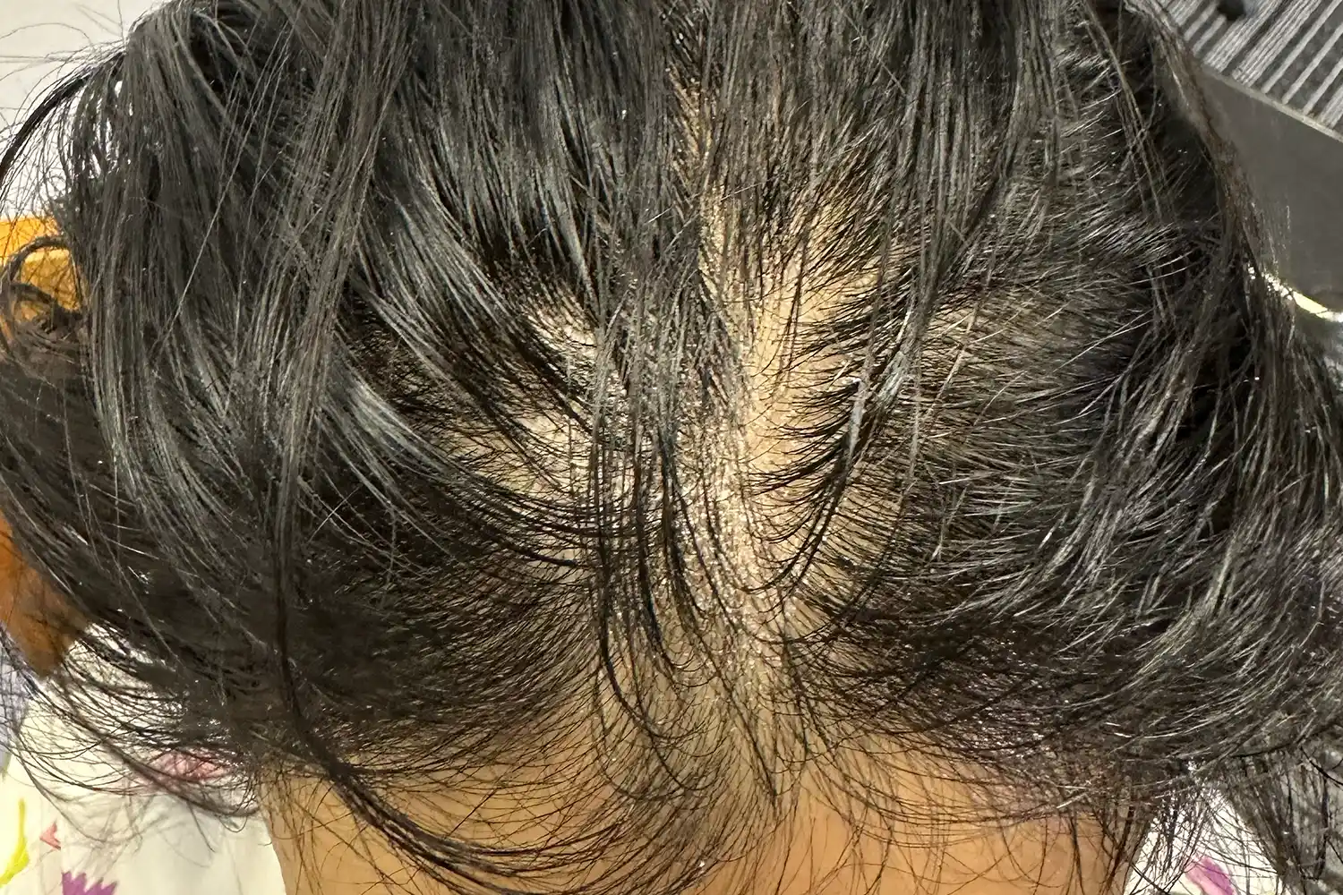 Before treatment, result 05
