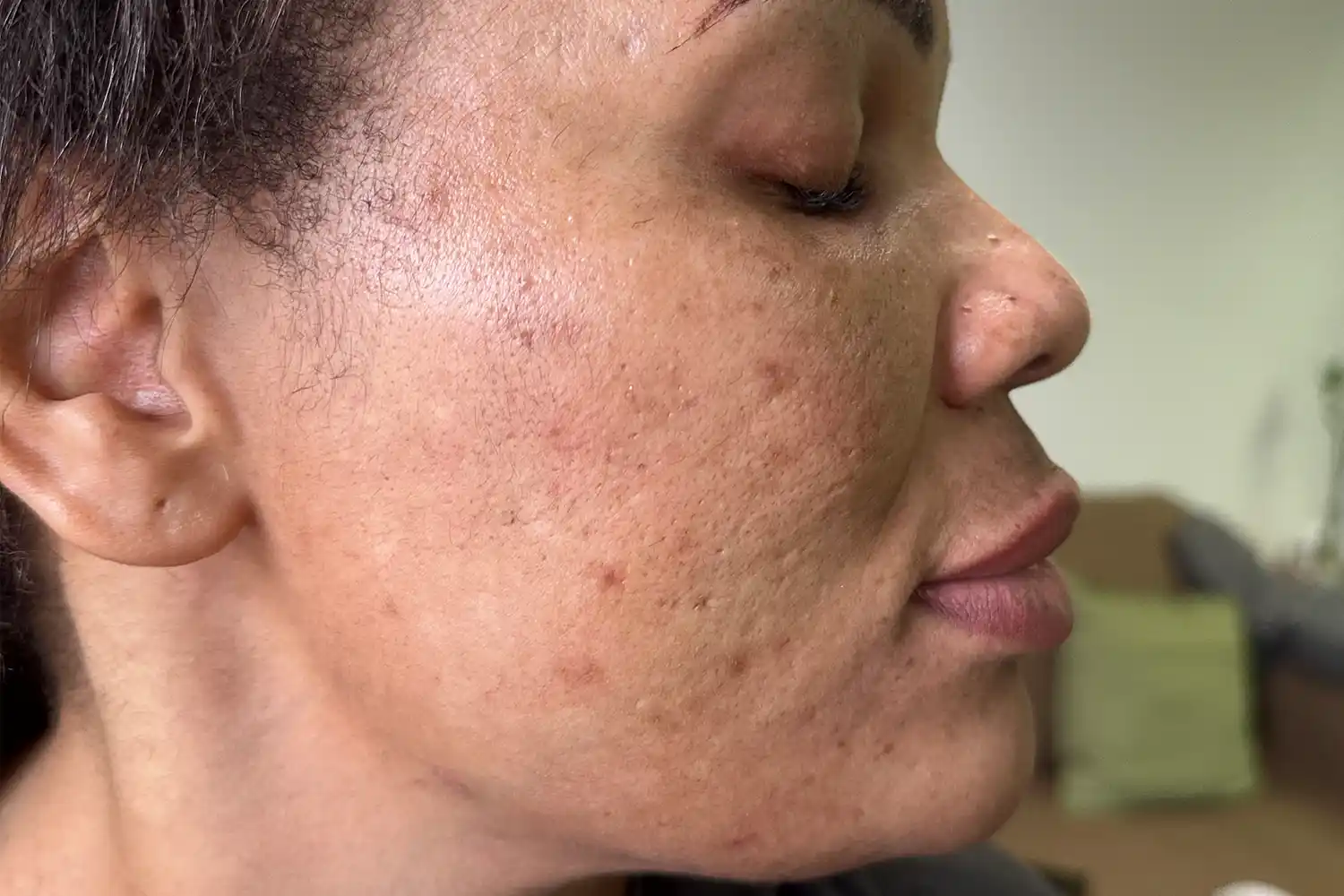 After VAMP treatment