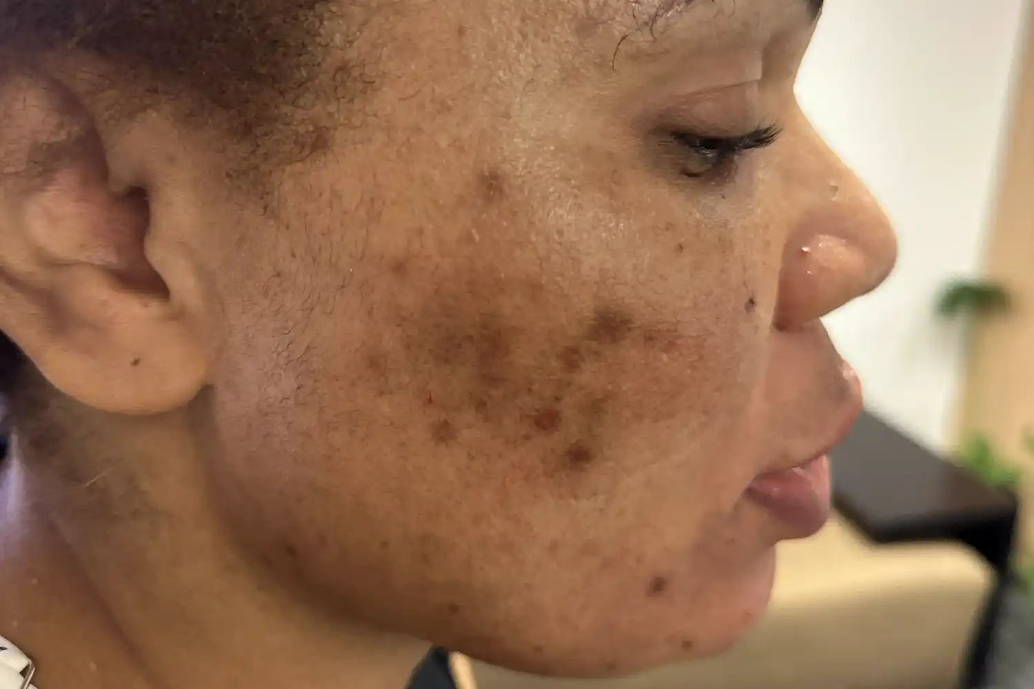 Before VAMP treatment