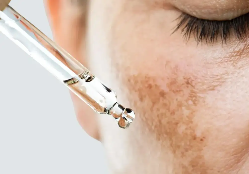 Hormonal Pigmentation and Melasma