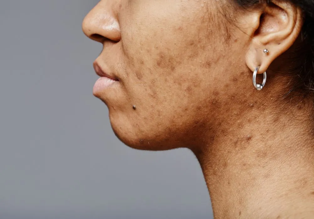 Pigmentation Overview