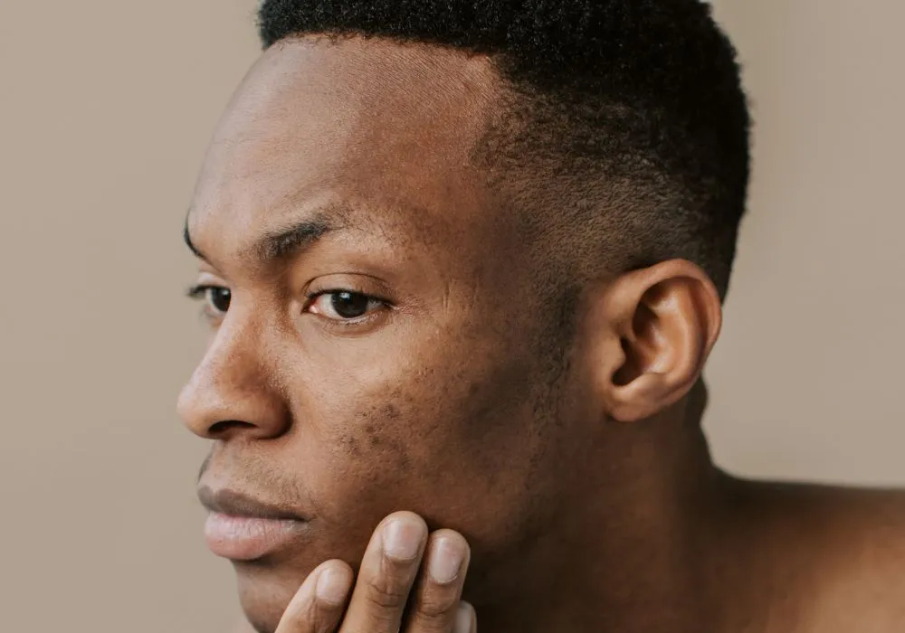 Post-Inflammatory Hyperpigmentation