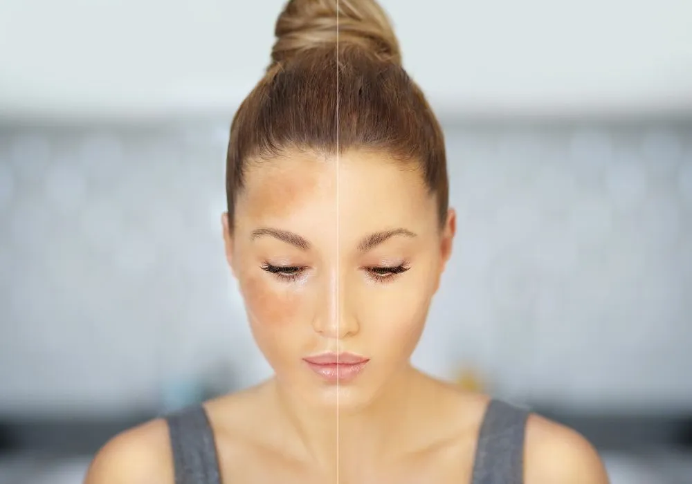 Why Melasma is Difficult to Treat